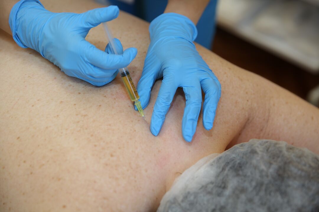 iniezioni di condroprotettori per la schiena