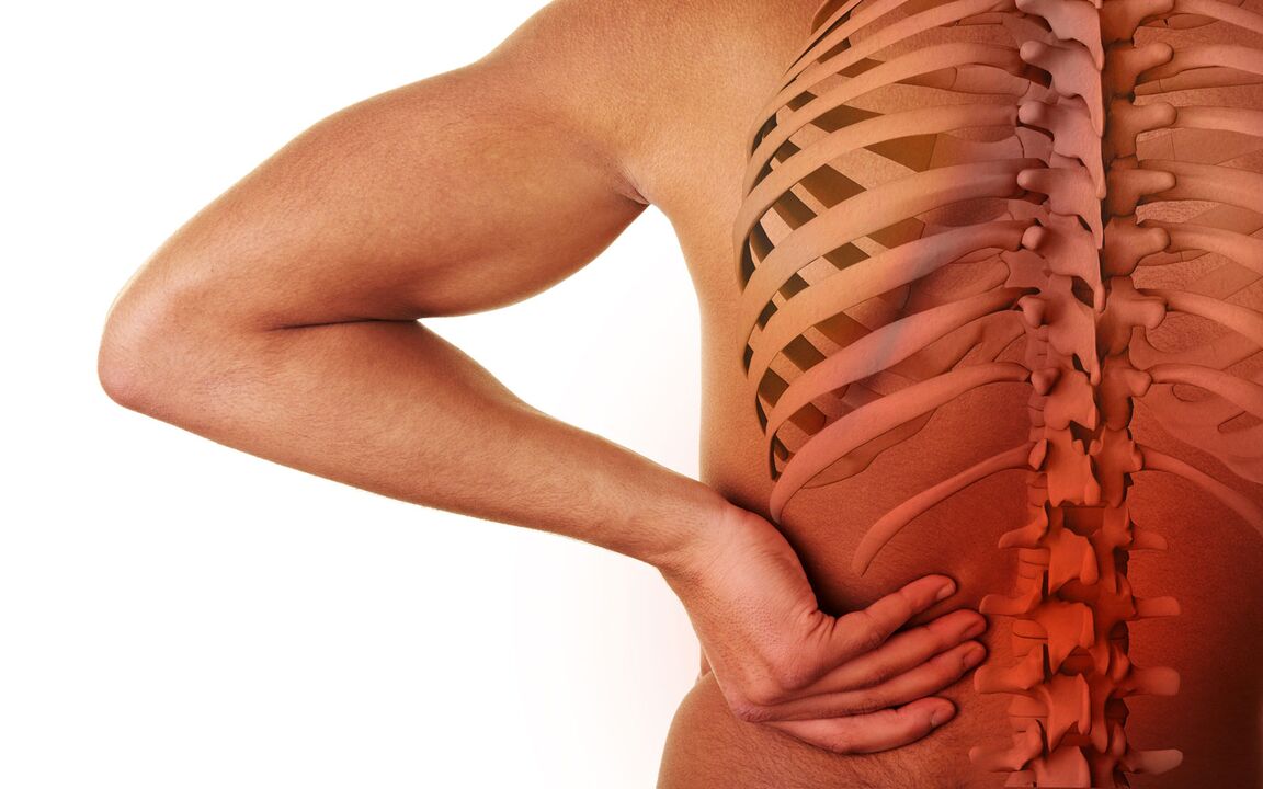 sintomi di osteocondrosi lombare